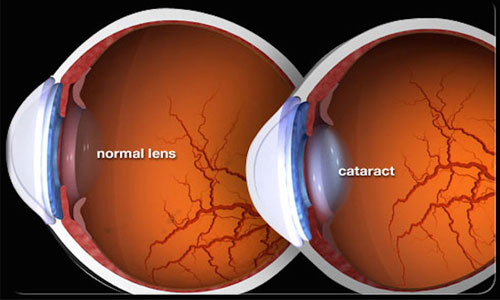 cataract illustration showing clear lens and cloudy lens